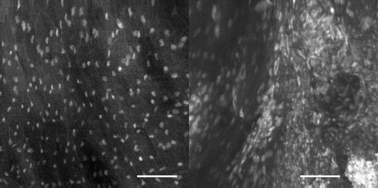 3. 宫颈癌.jpg 3. 宫颈癌.jpg